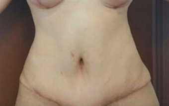25-34 year old woman treated with Tummy Tuck after 2473250