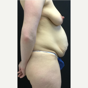 35-44 year old woman treated with Breast Lift with Implants before 3219393