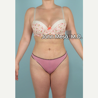 25-34 year old woman treated with Brazilian Butt Lift after 3777625