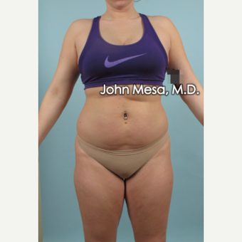 25-34 year old woman treated with Brazilian Butt Lift before 3777625