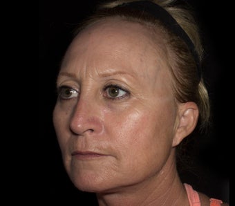 35-44 year old woman treated with Cheek Lift before 1653581