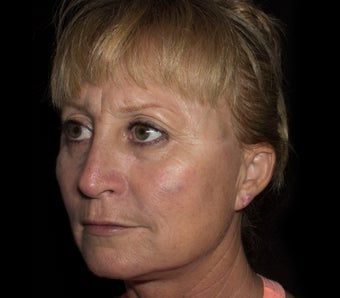 35-44 year old woman treated with Cheek Lift after 1653581