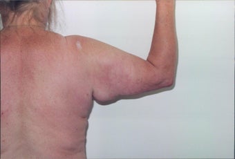 Arm lift - Female before 216940