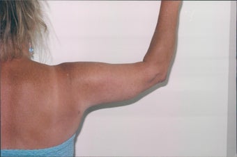 Arm lift - Female after 216940