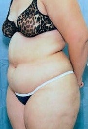 52 year old woman treated with Liposuction of the upper and lower Abdomen, Thighs before 1581433