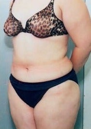 52 year old woman treated with Liposuction of the upper and lower Abdomen, Thighs after 1581433