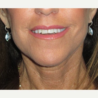 65-74 year old woman treated with Fat Transfer and face/neck lift after 1710954