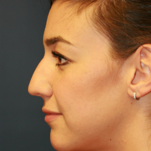 18-24 year old woman treated with Rhinoplasty before 3559779