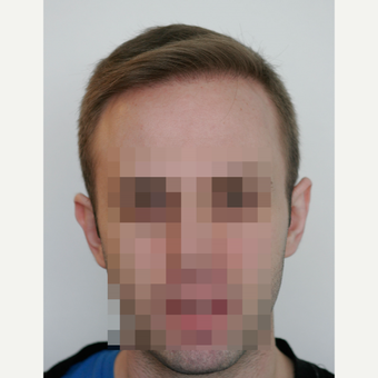 25-34 year old man treated with FUE Hair Transplant after 3682611