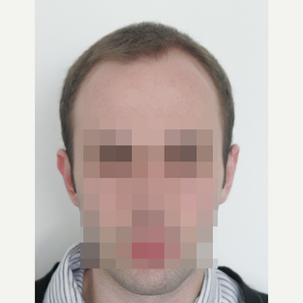 25-34 year old man treated with FUE Hair Transplant before 3682611