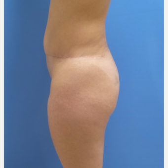 38 year old woman treated with Butt Implants before 3836499