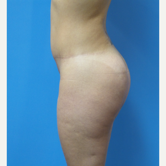 38 year old woman treated with Butt Implants after 3836499