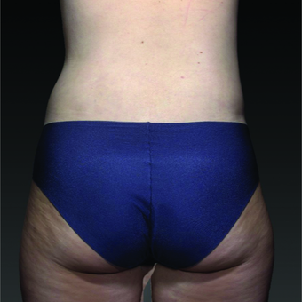 35-44 year old woman treated with Smart Lipo after 3803753