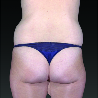 35-44 year old woman treated with Smart Lipo before 3803753
