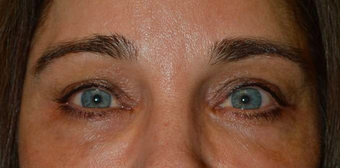 Middle age female, with sunken hollow eyes, who received upper eyelid filler injection. after 2479746