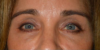 Middle age female, with sunken hollow eyes, who received upper eyelid filler injection. before 2479746