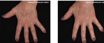 Hand Rejuvenation with Perlane before 1088375