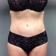 45-54 year old woman treated with Tummy Tuck after 1839200