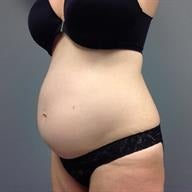 45-54 year old woman treated with Tummy Tuck 1839200