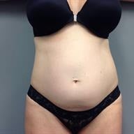 45-54 year old woman treated with Tummy Tuck before 1839200
