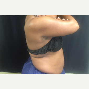 45-54 year old woman treated with CoolSculpting after 3390626