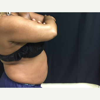 45-54 year old woman treated with CoolSculpting before 3390626