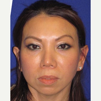 Mid Facelift after 1782385