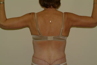 arm lift 1060309