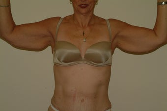 arm lift before 1060309