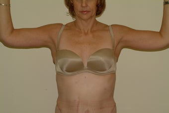 arm lift after 1060309