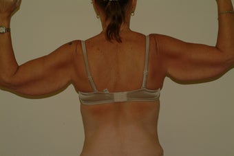 arm lift 1060309
