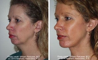Facelift with Chin Implant, Dermabrasion before 91929