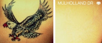 Color Tattoo Removal before 1437536