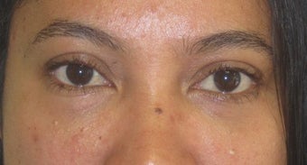 Tear trough deformity (orbital rim hollowying) and loss of midface volume. The dark shadows are a result of a loss of volume in after 1032183