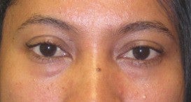 Tear trough deformity (orbital rim hollowying) and loss of midface volume. The dark shadows are a result of a loss of volume in before 1032183