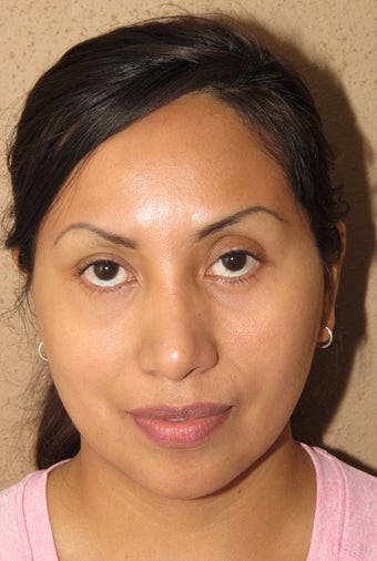 Facial remodeling with lower blepharoplasty and midface lift after 1013057