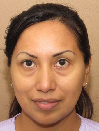 Facial remodeling with lower blepharoplasty and midface lift before 1013057