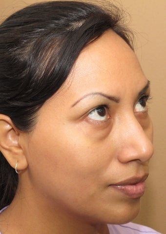 Facial remodeling with lower blepharoplasty and midface lift 1013057