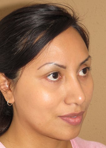 Facial remodeling with lower blepharoplasty and midface lift 1013057