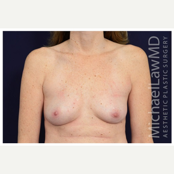 35-44 year old woman treated with Breast Implant Revision after 3258999