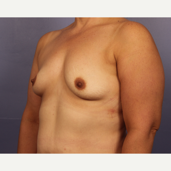 45-54 year old woman treated with Breast Augmentation before 3671540