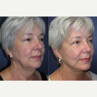60 year old woman treated with Facelift before 3465424