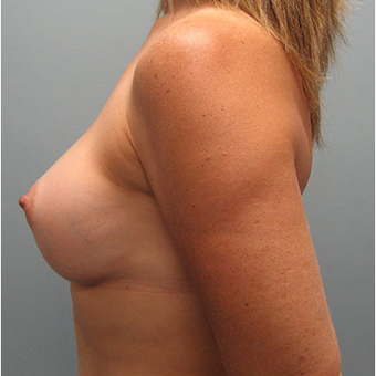 45 year old woman treated with Breast Augmentation after 3468379