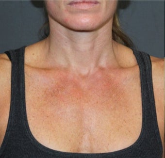 IPL to the Chest before 3649840