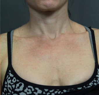 IPL to the Chest after 3649840