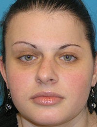 Foundation Rhinoplasty before 52477