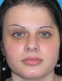 Foundation Rhinoplasty after 52477