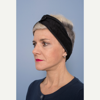 55-64 year old woman treated with Facelift after 3329023