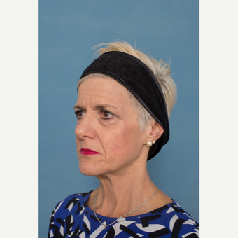 55-64 year old woman treated with Facelift before 3329023