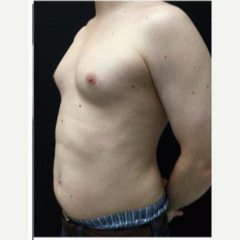 25-34 year old man treated with Male Breast Reduction before 3218522